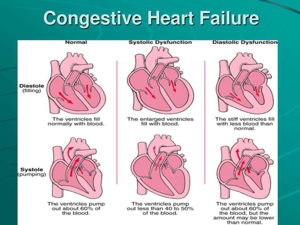 What Is Congestive Heart Disease