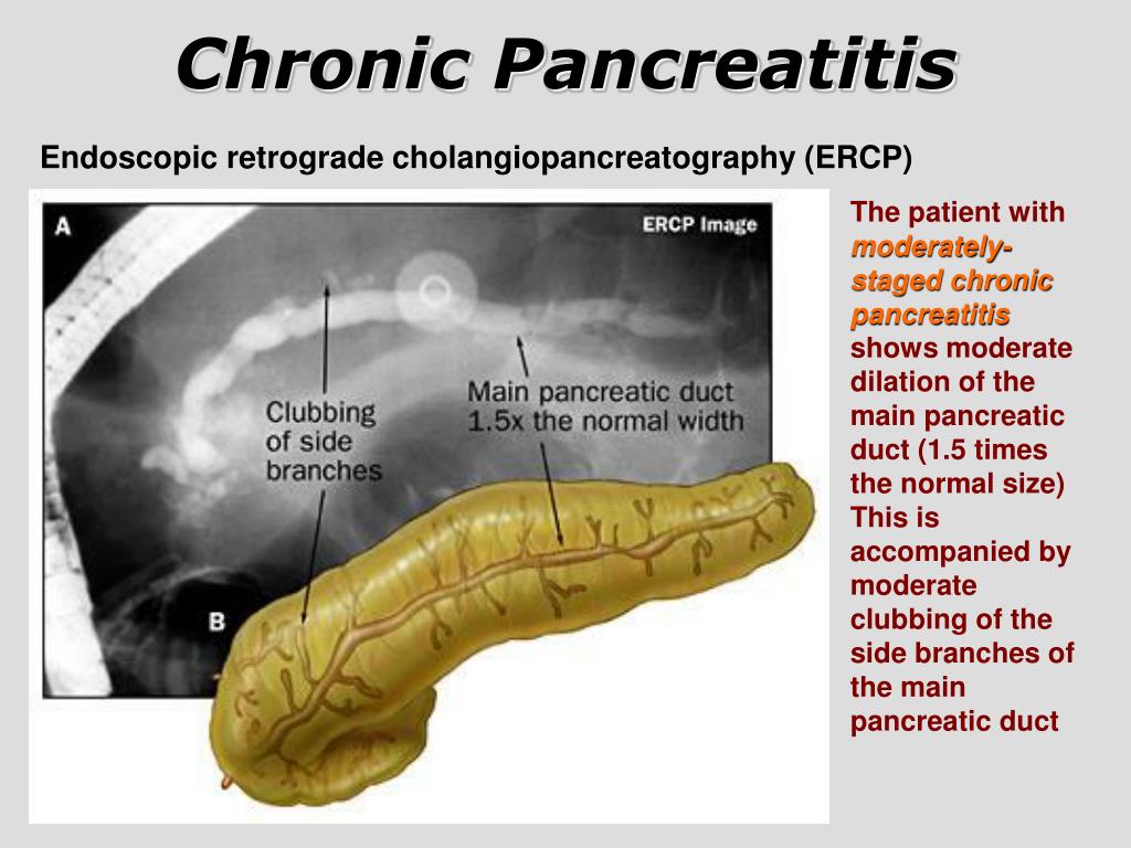 Может ли панкреатит. Endoscopic Retrograde Cholangiopancreatography ERCP.