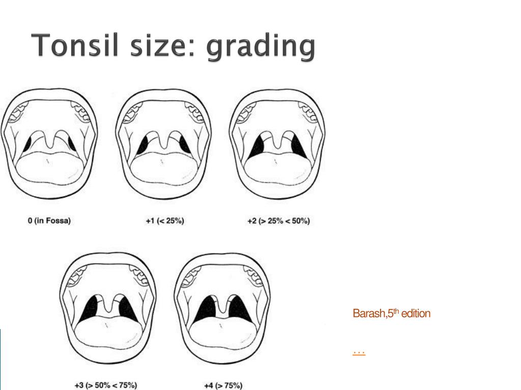 Is tonsillitis airborne Is Tonsillitis Contagious? Infection