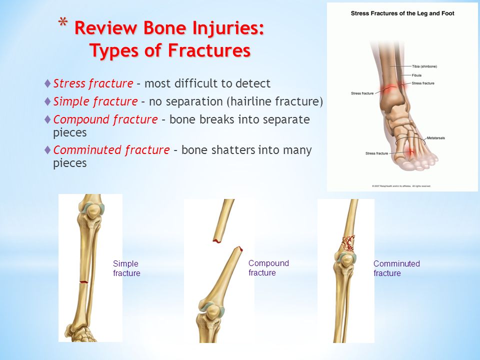 Поставить на 4 кости. Bone Joint muscle injuries.
