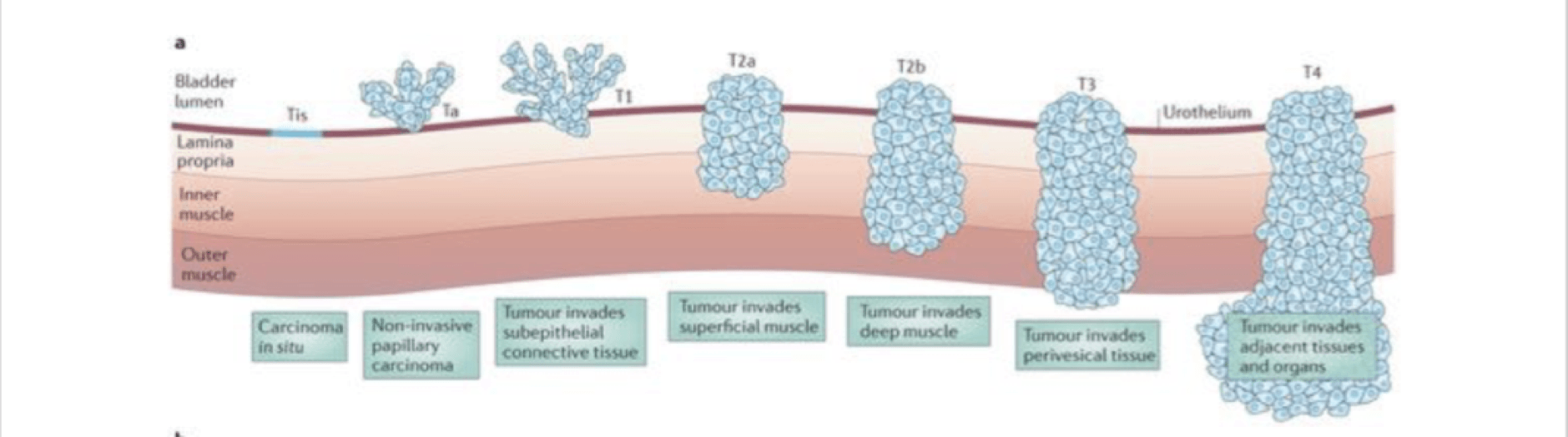 Паравезикальная клетчатка. Опухоли мочевого пузыря патогенез. Опухоль мочевого пузыря в стадии т3:. Злокачественные новообразования мочевого пузыря классификация. Гистологическая классификация опухолей мочевого пузыря.