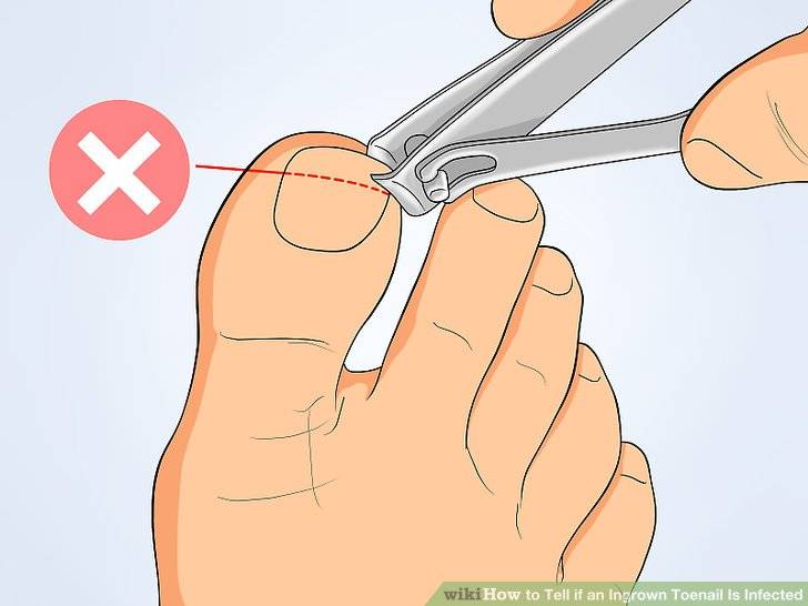 Ногтями можно резать. Вырезание вросшего ногтя.