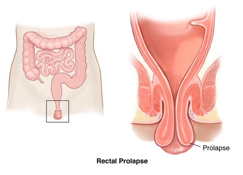 Rectal Prolapse Signs Rectal Prolapse Symptoms Causes Treatment