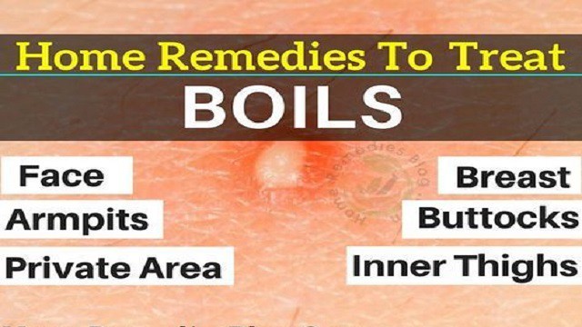 What Causes A Boil On Your Back Boils Causes Symptoms Treatment