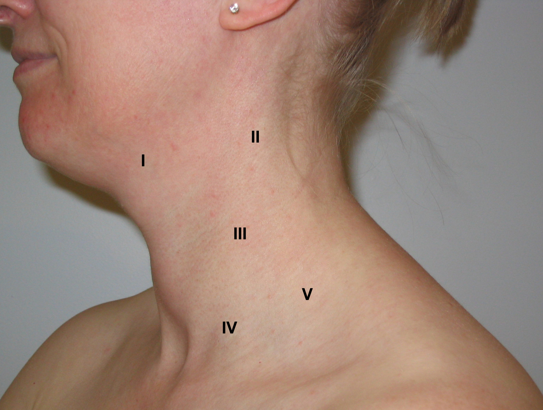 lymph node swollen back of neck