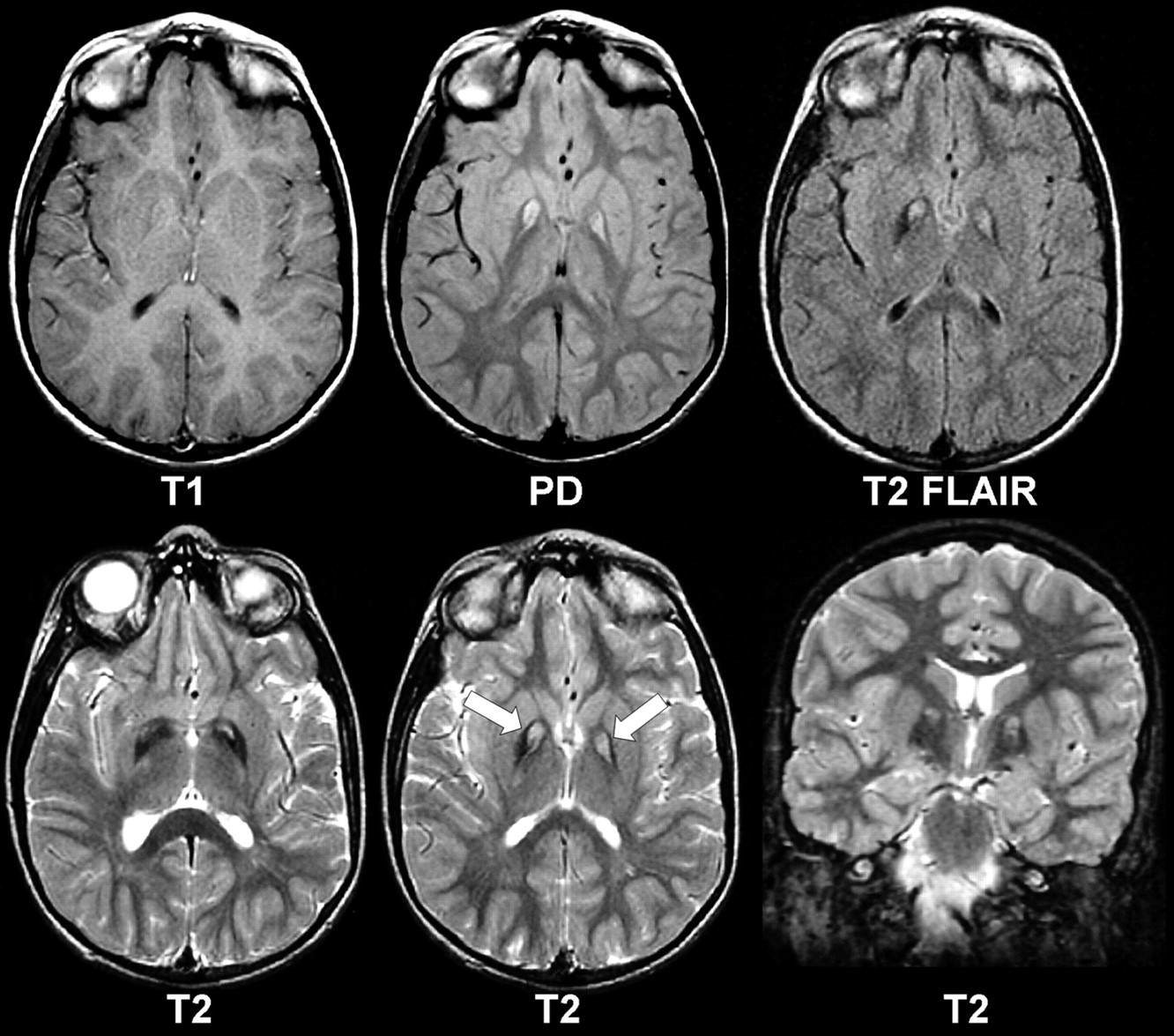 Патологии на мрт. Компьютерная томография кт головного мозга. Кт томограмма головного мозга. Галлервордена Шпатца кт.