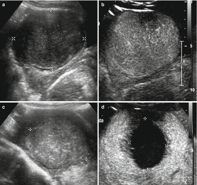 Uterine Fibroid Size Chart In Cm 