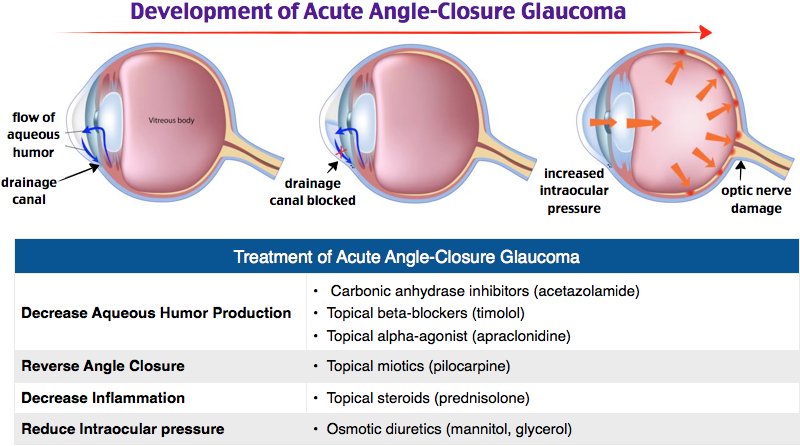 Глаукома латынь. Транссклеральная циклокоагуляция. Лазерная транссклеральная циклокоагуляция. Циклофотокоагуляция при глаукоме. Циклокоагуляция при глаукоме.