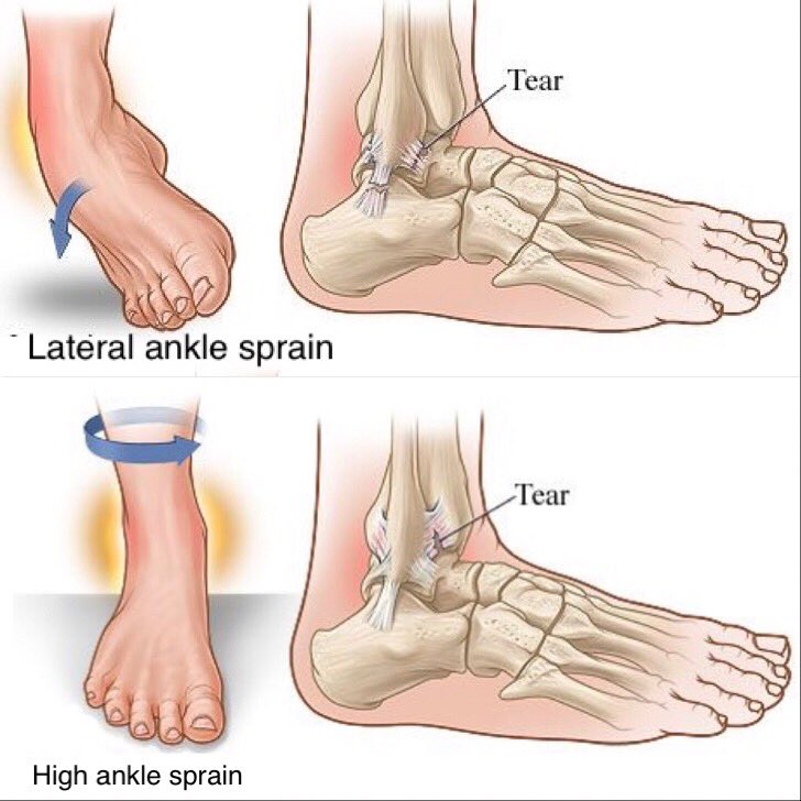Guide Physical Therapy Guide to Ankle Sprain.