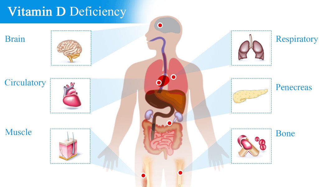 Vitamin deficiency. Vitamin d deficiency. Vitamin d deficiency Symptoms. Consequences of Vitamin d deficiency. Vitmain d deficiency Symptoms.