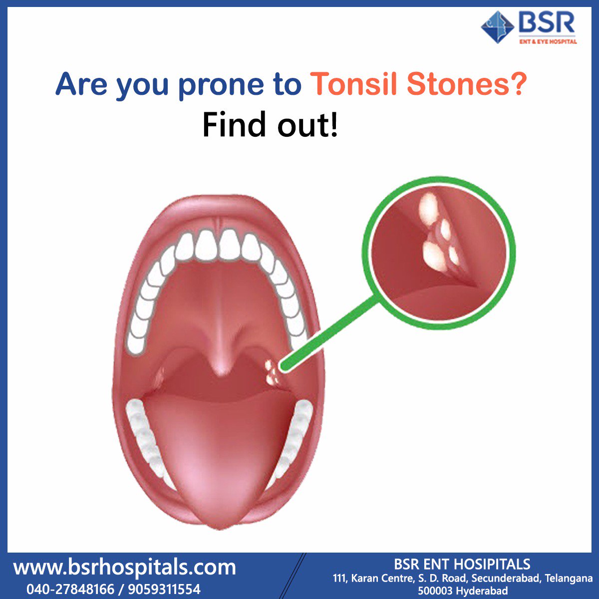 Dr berg tonsil stones