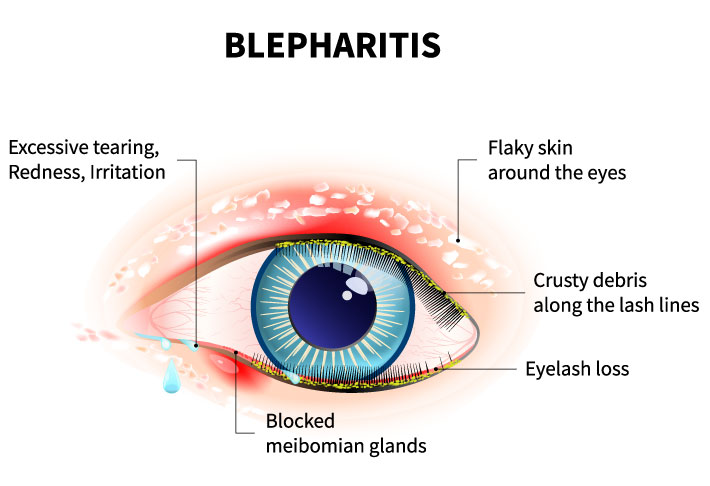 Зона глаз. Blepharitis перевод с латинского.