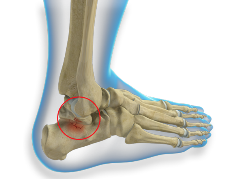 Голеностопный сустав левой ноги. Лодыжка у человека анатомия перелом. Трещина голеностопного сустава.