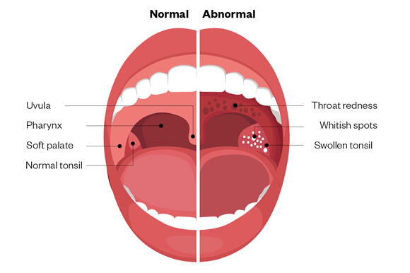 Pharyngitis (sore throat) and Strep Throat.