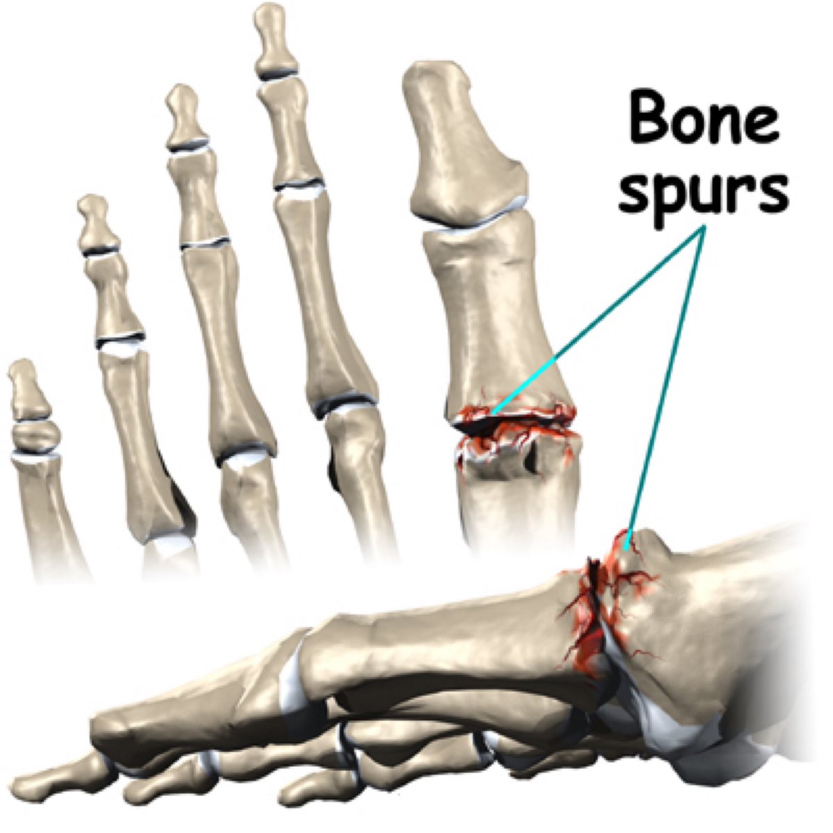 Define Bone Spur Bone Spurs Symptoms And Causes 8862