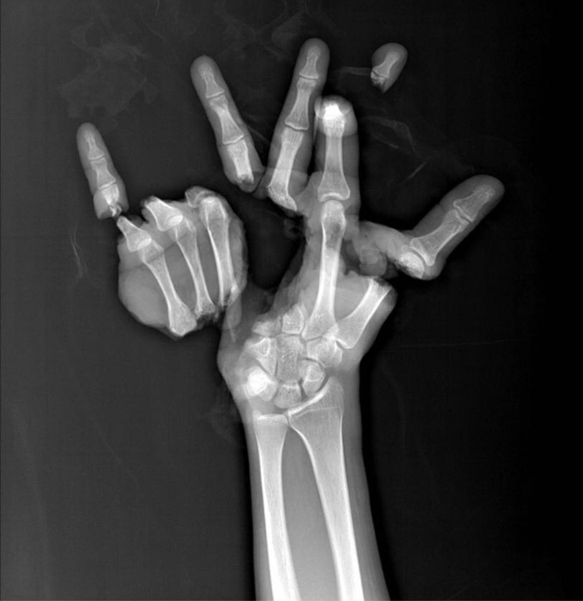 Top 91+ Images pictures of broken pinky finger Stunning