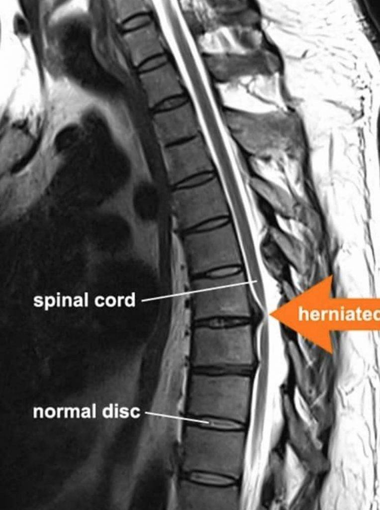 Fractured discs: Spine fracture, Spinal fractures, vertebral fractures ...