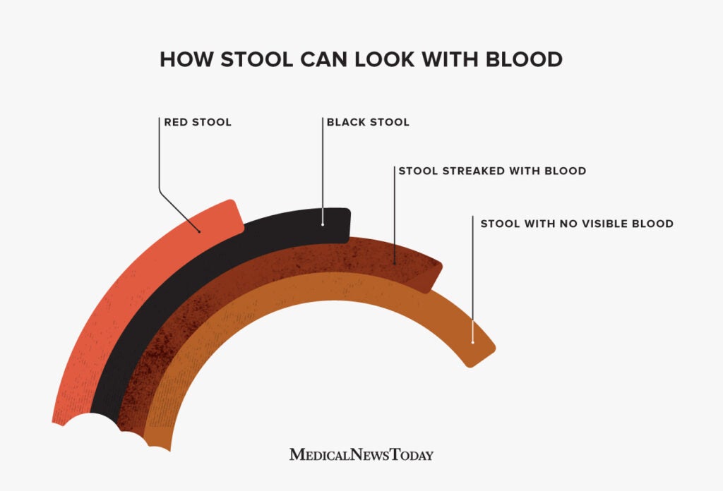 Bright red blood in stool diverticulitis: Diverticular Bleeding | Cigna