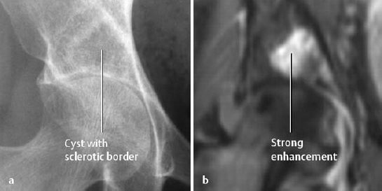 Subchondral Degenerative Cysts Subchondral Bone Cyst Symptoms Causes And Treatments 2878