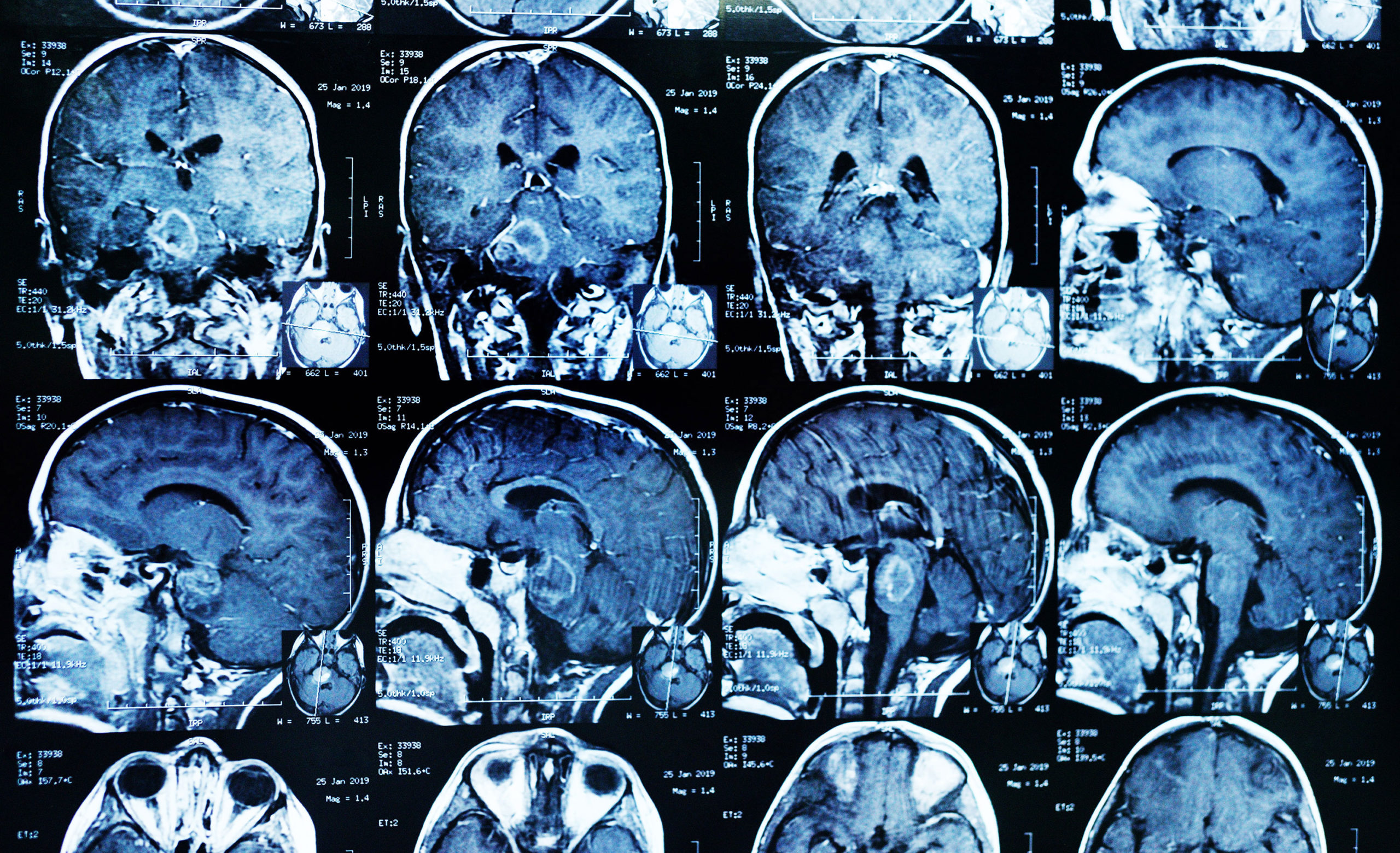 Нейрохирургия мозг. Снимок головного мозга. Опухоль головного мозга на кт. Кт снимок. Мрт снимки.