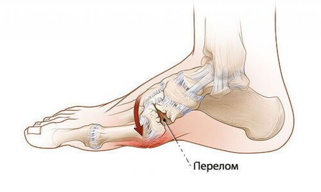 Почему не двигается нога. Диабетическая остеоартропатия (стопа Шарко). Трещина ладьевидной кости стопы.