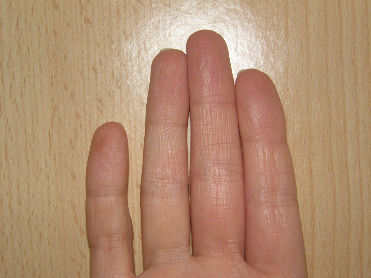 What Causes Red Swollen Finger Joints