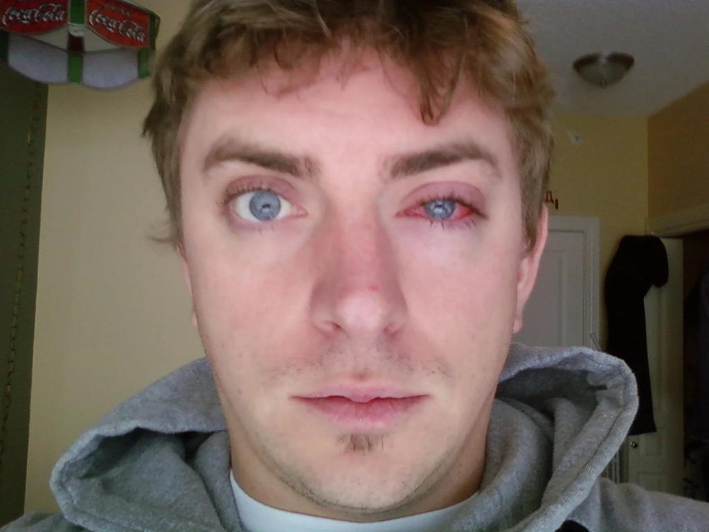 Swollen Eyes Hives Hives Urticaria And Angioedema Symptoms Causes