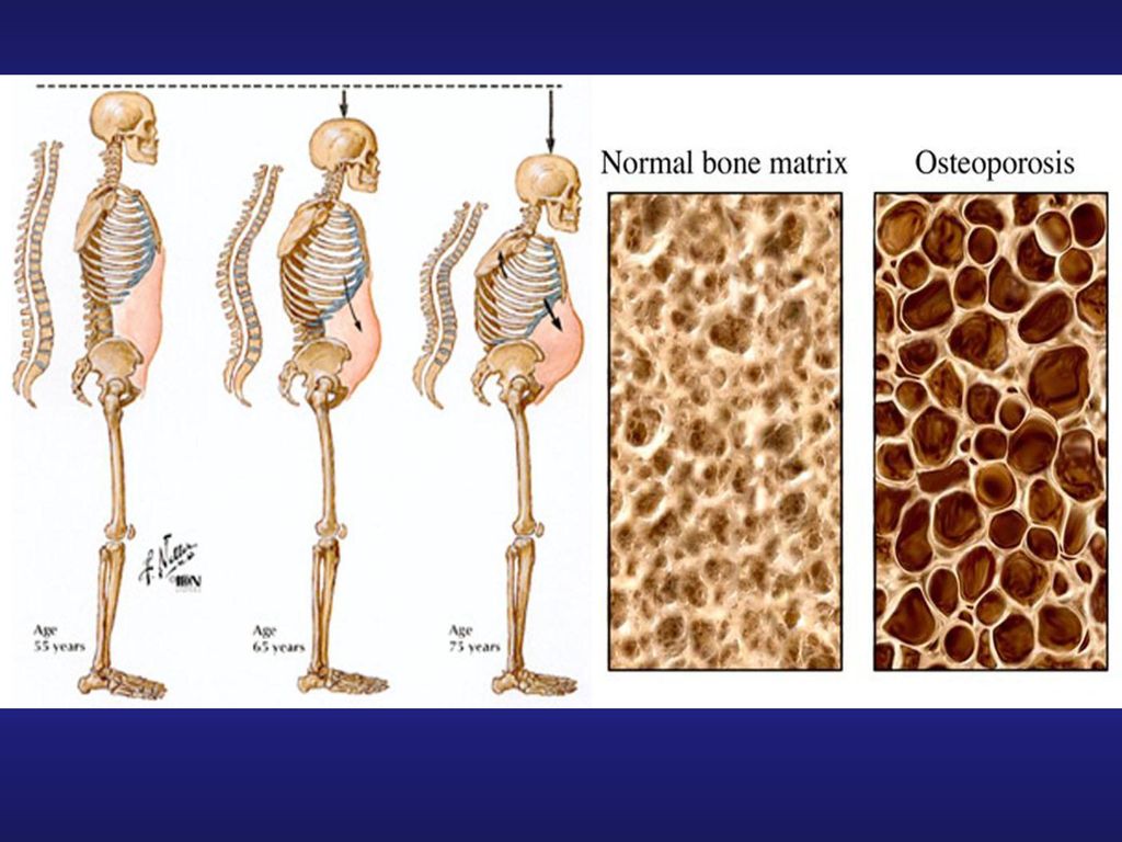 what-is-normal-bone-density-range-bone-density-test-osteoporosis