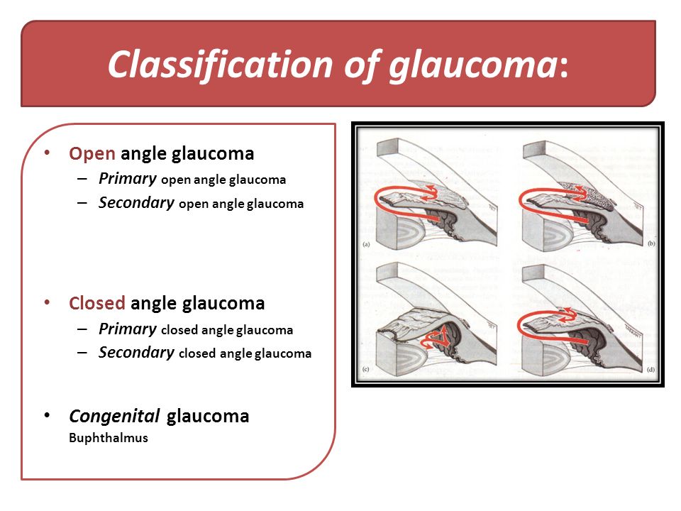 Signs of closed angle glaucoma: Glaucoma – Symptoms and causes