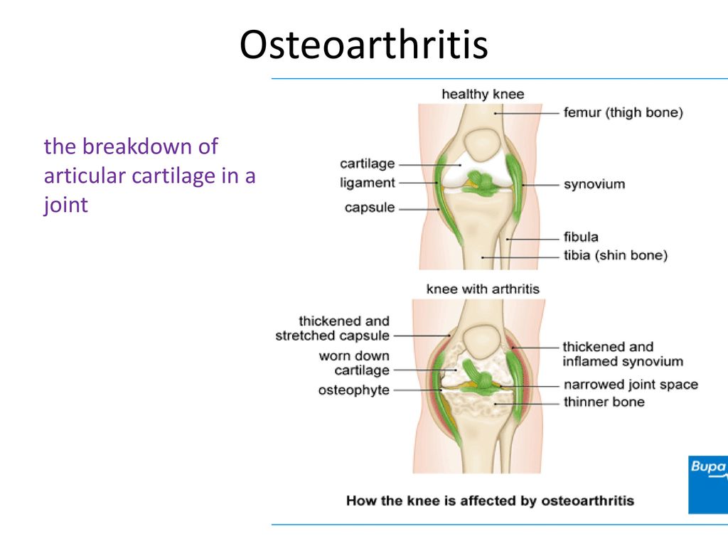 Osteophytes In Osteoarthritis Bone Spurs Symptoms And Causes 8120