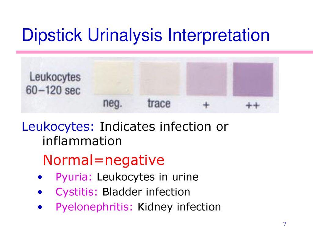 Trace Intact Blood Urine Urine Test Definition Disease Detection And 