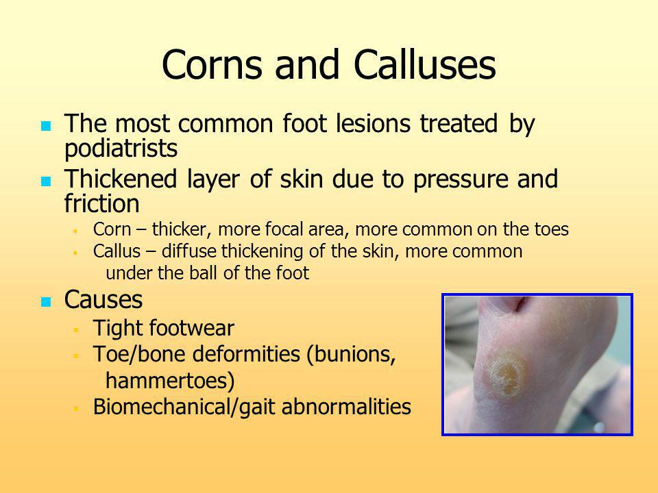 Callus between my toes: Treatment, Symptoms, Signs & Causes