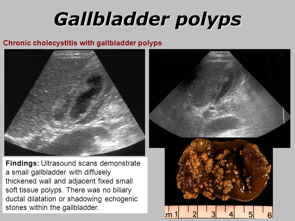 Gallbladder cholesterol polyp: Diagnosis and Management of Gallbladder ...