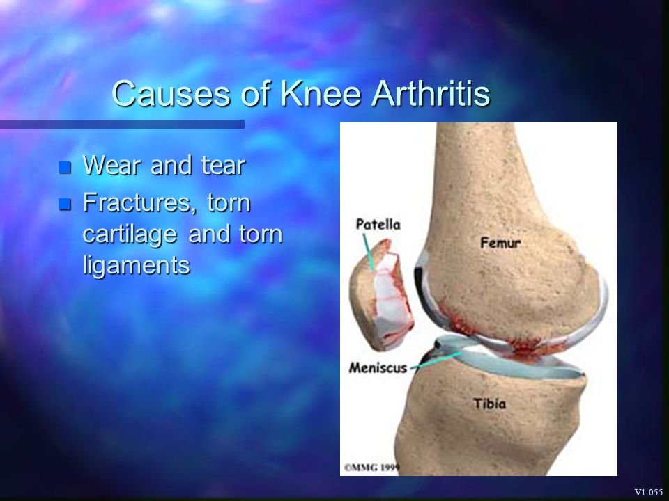 Types of knee diseases: Knee pain – Symptoms and causes