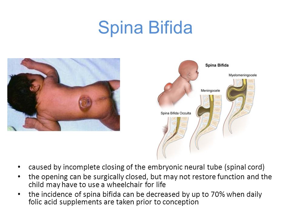 Inheritance Of Spina Bifida Spina Bifida A Review Of The Genetics