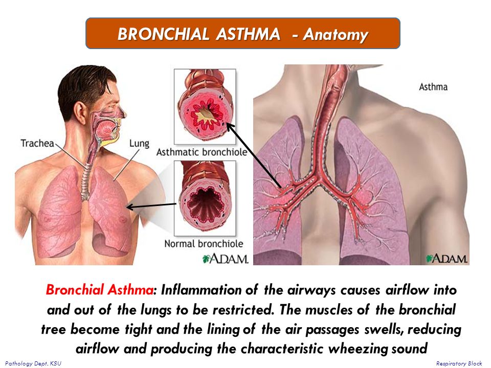Bronchial asthma. “Asthma bronchial….” (Бронхиальная астма):.
