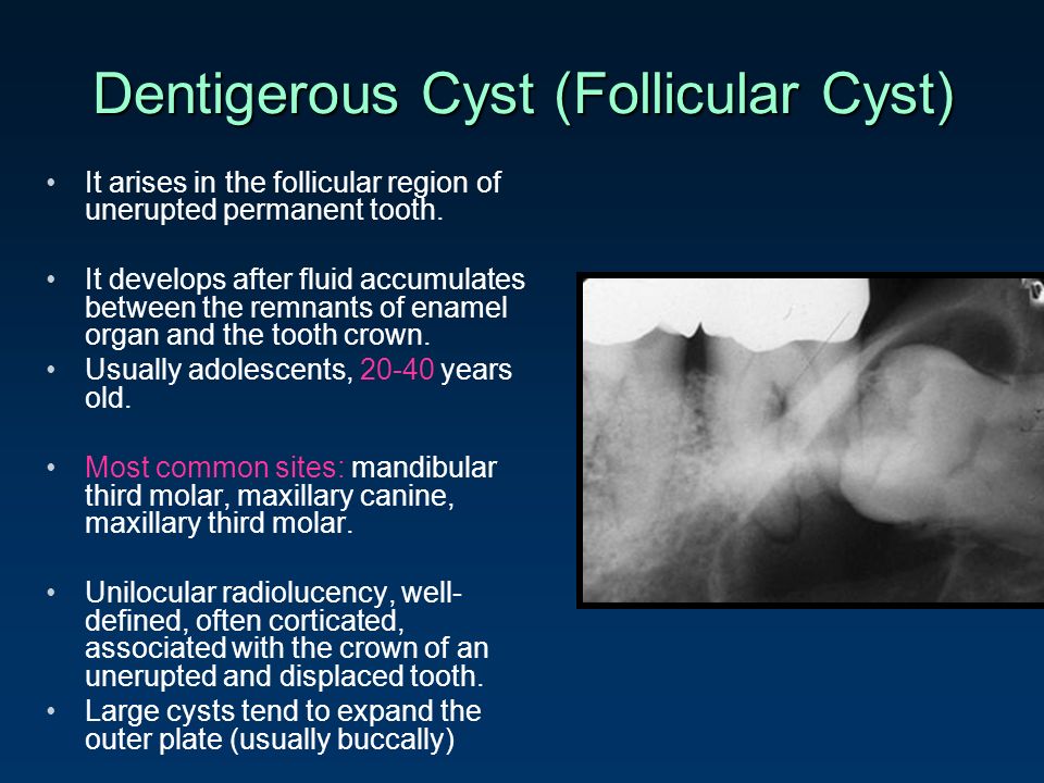 Small Cyst On Chest: Epidermoid Cysts – Symptoms And Causes