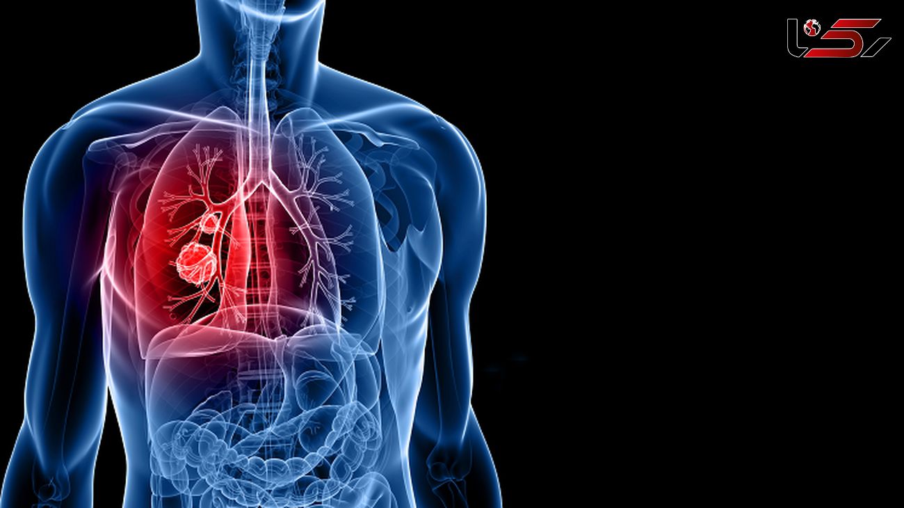 Steroid pack for bronchitis Acute Bronchitis Treatment, Symptoms, Causes, Home Remedies