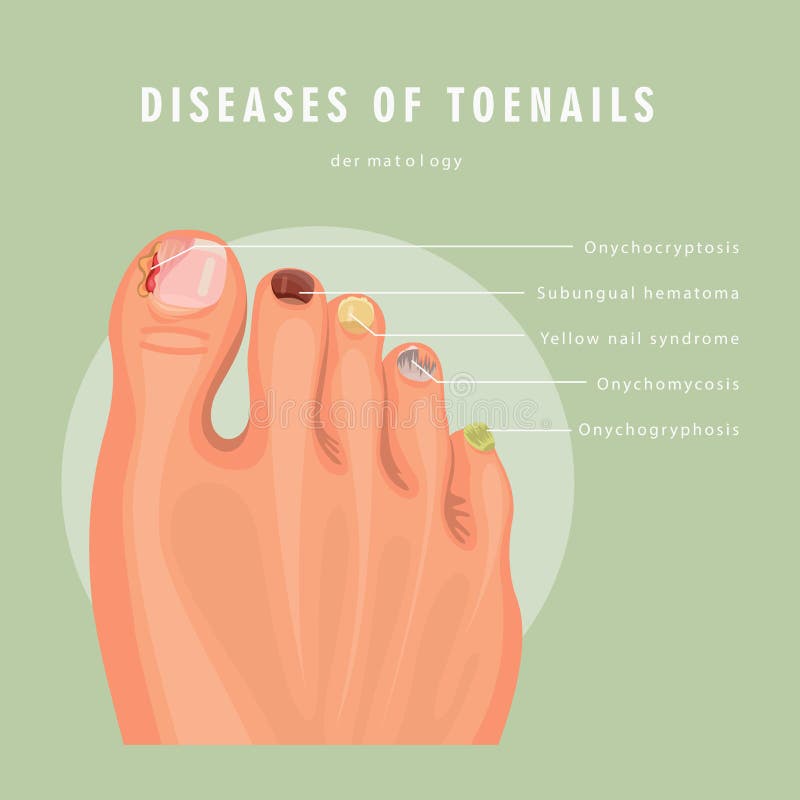 List Of Nail Diseases Optimal Diagnosis And Management Of Common Nail Disorders 6579