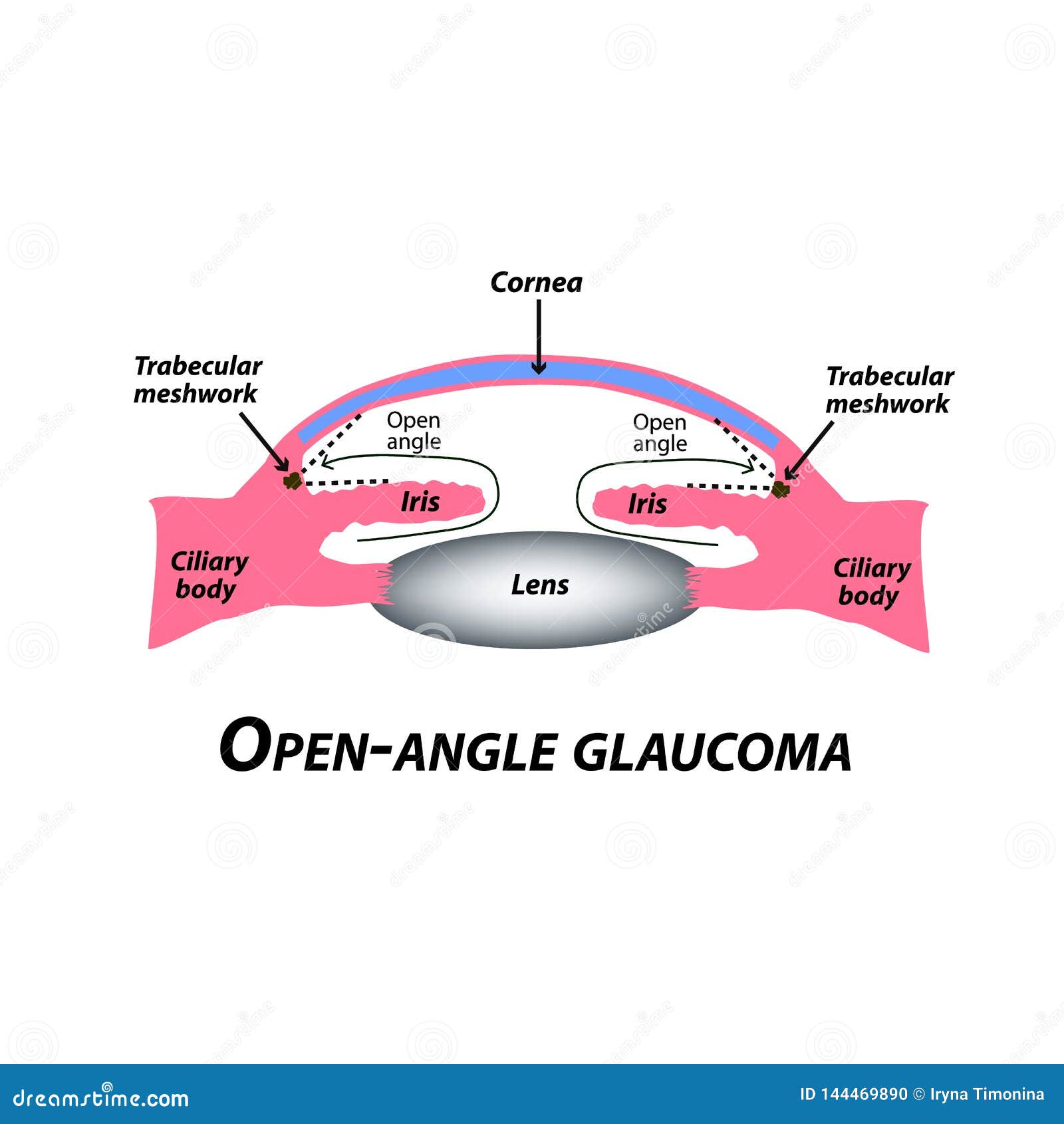 Primary open angle glaucoma signs and symptoms: Open-Angle Glaucoma ...