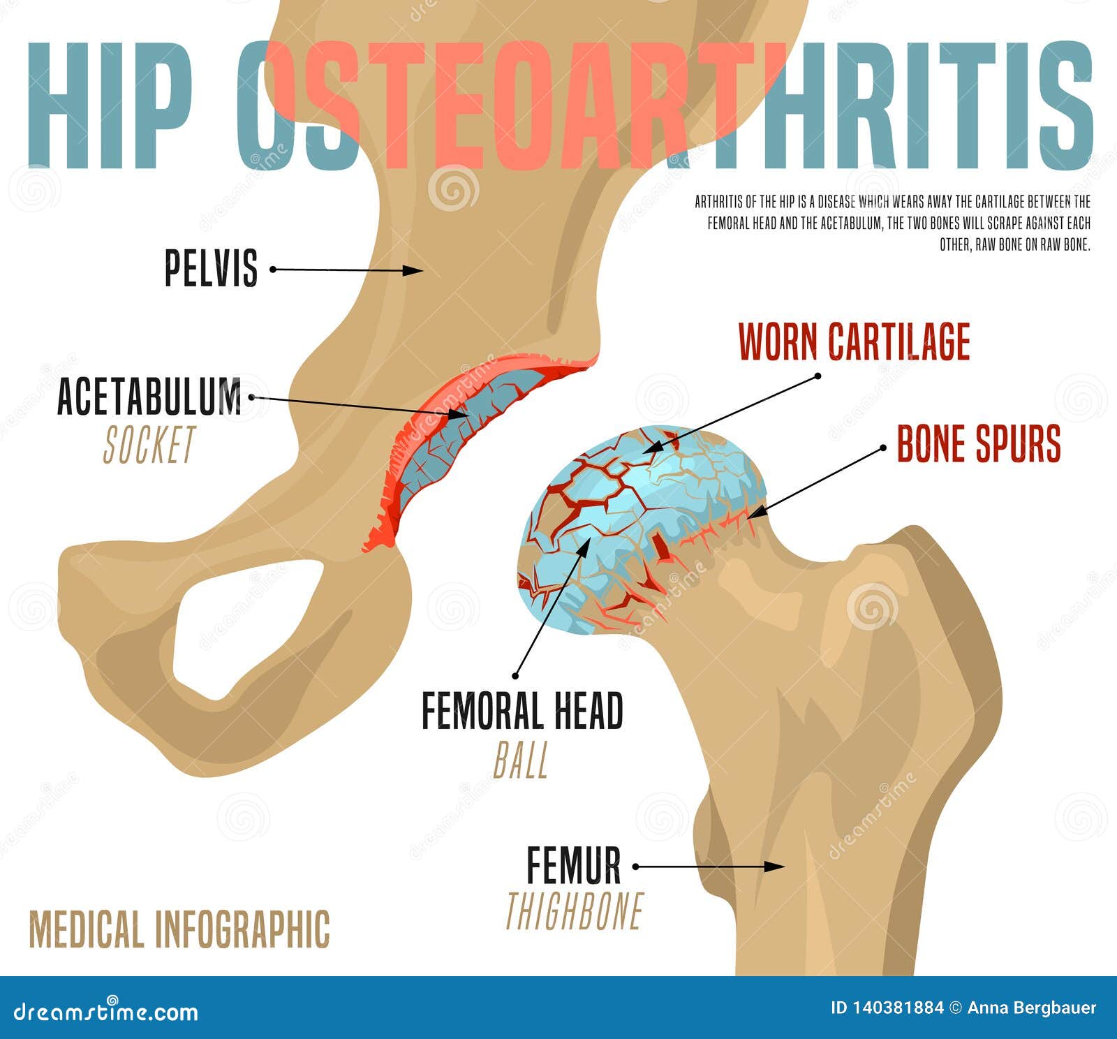 Bone Spurs Pelvic Area Hip Bone Spurs Symptoms And Treatment