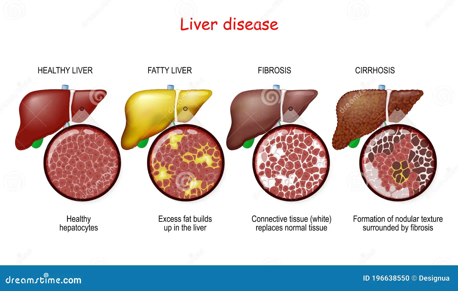 Itchy skin liver failure Types of Liver Problems, Causes, and More