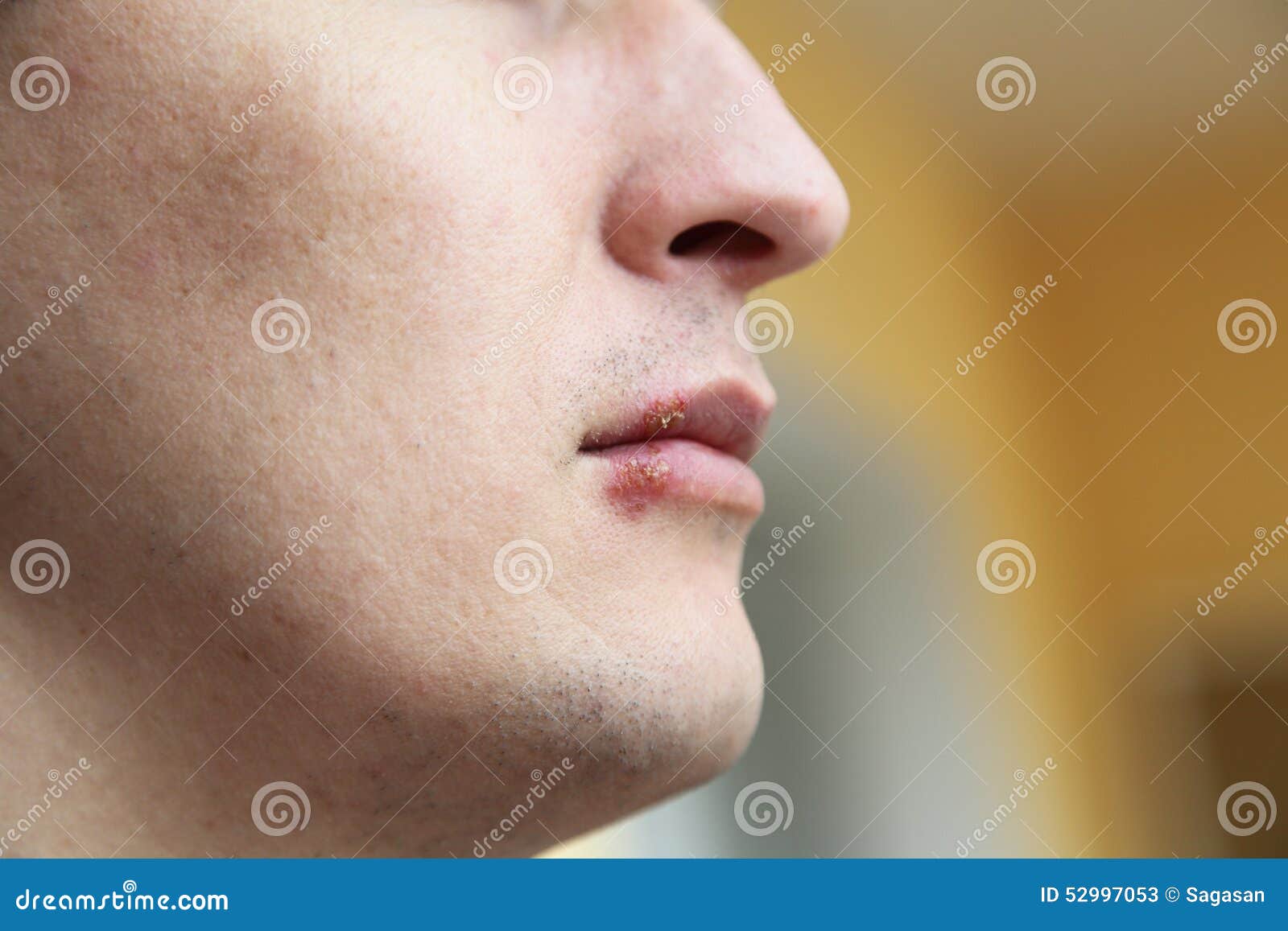 herpes-on-the-nose-images-pictures-of-viral-skin-diseases-and-problems