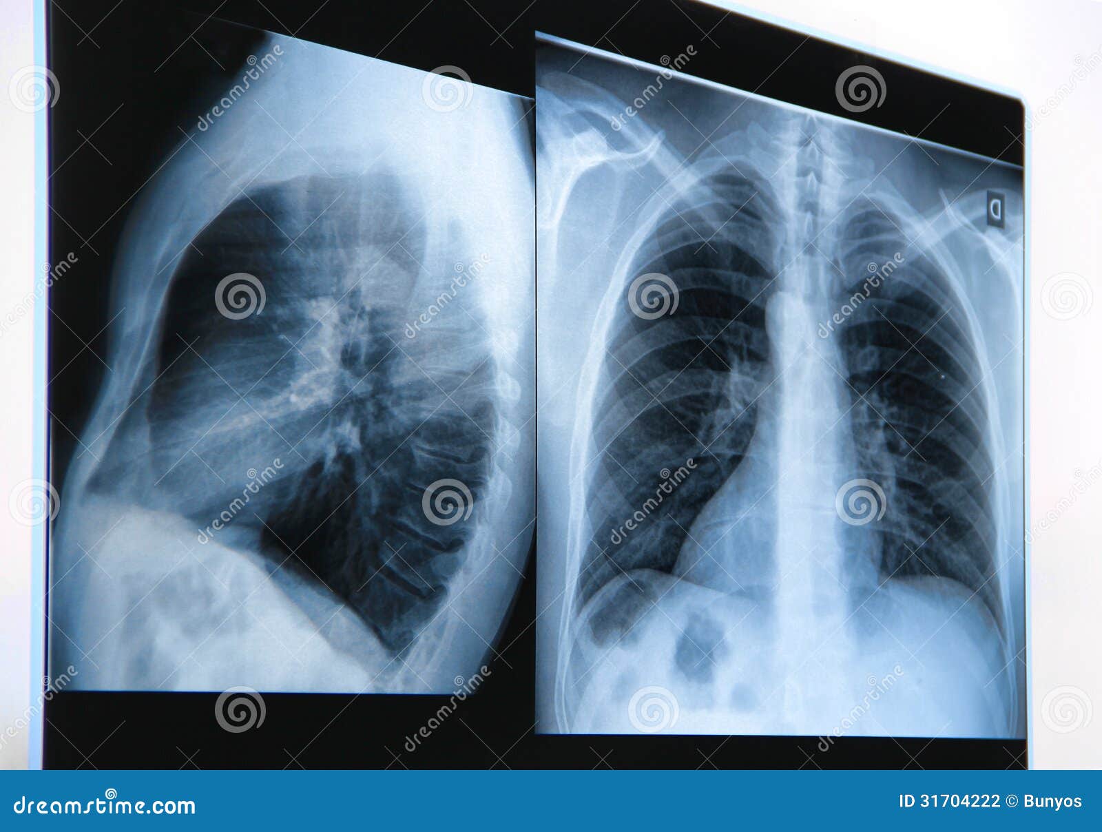 What does chest xray show if smoker The difference between a smoker’s