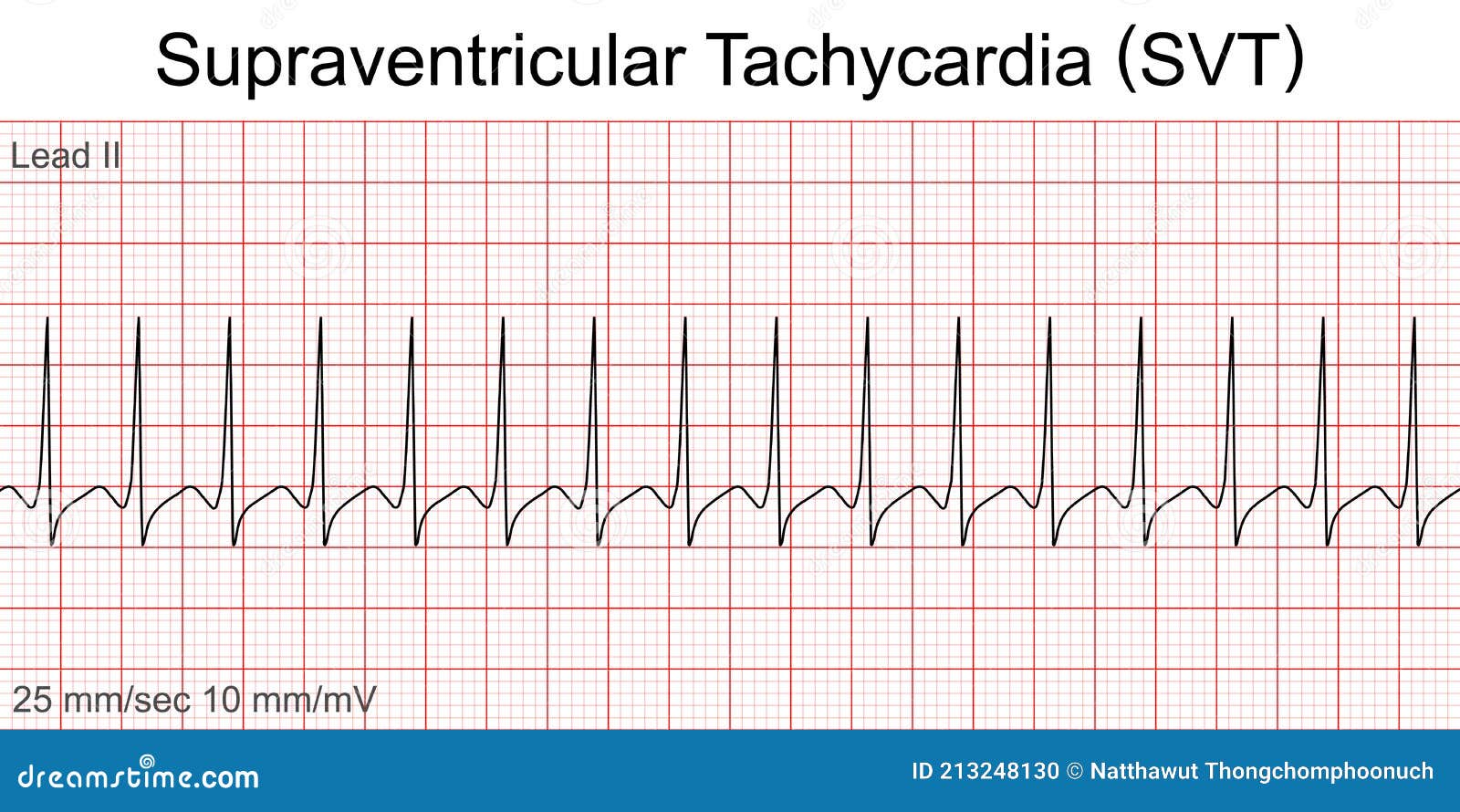 What is svt in medical terms Supraventricular tachycardia Symptoms