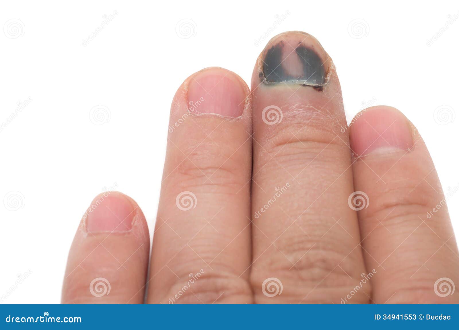 Bruised fingernail cuticle What To Do for a Bruised Nail Cleveland