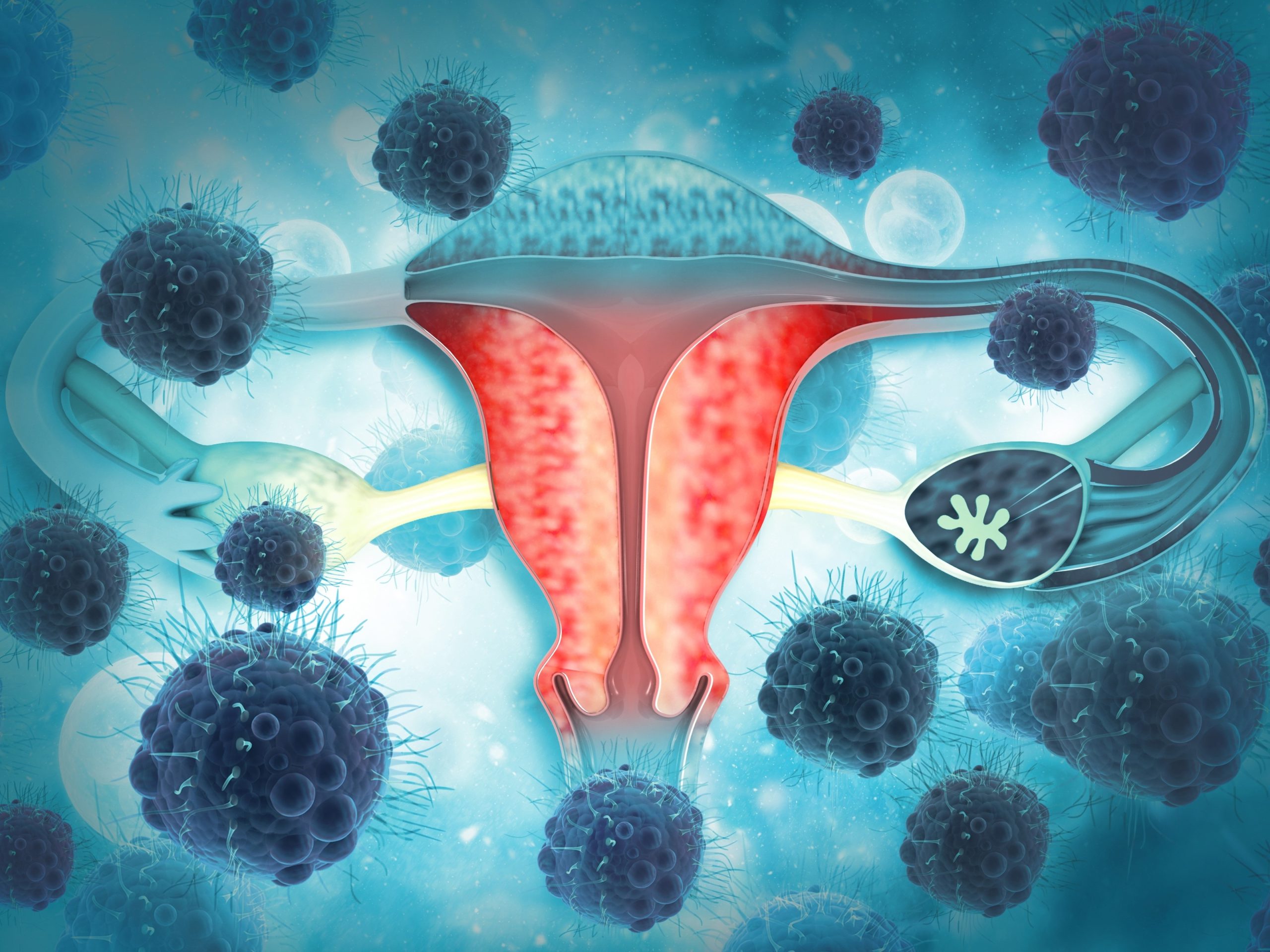 Рак после удаления яичников. Злокачественные новообразования яичников. Болезни женской репродуктивной системы. Терапия опухолей яичников. Злокачественные опухоли яичников.