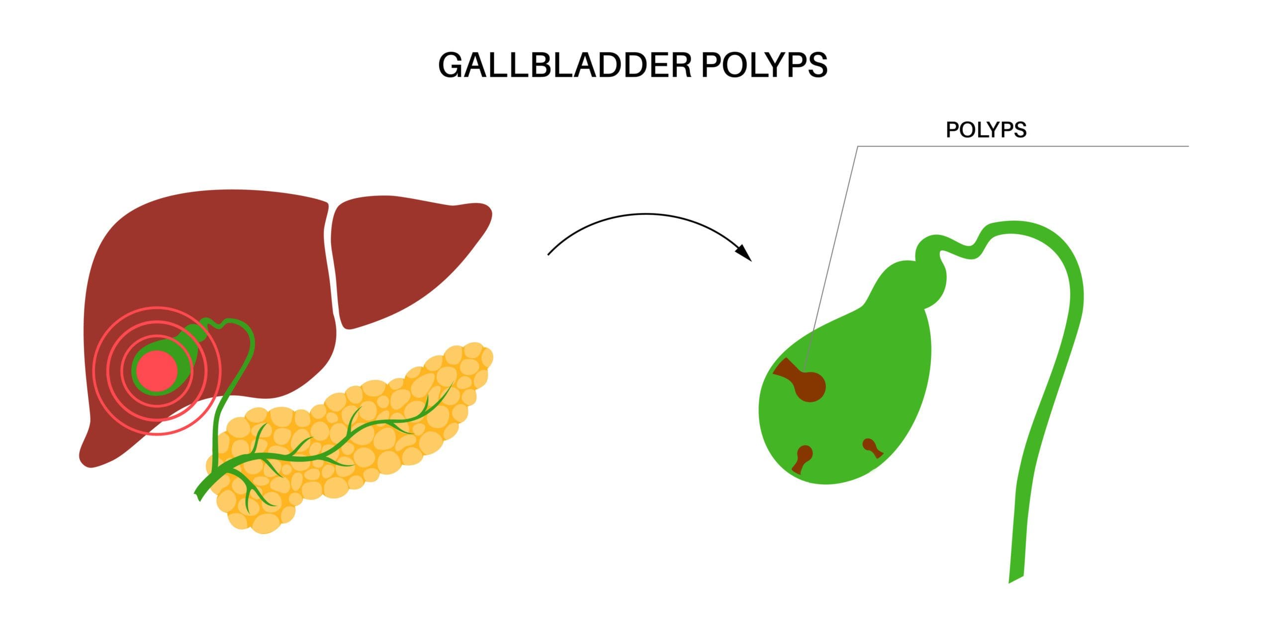 Polyps in gallbladder cause pain: Gallbladder polyps: Symptoms, causes ...