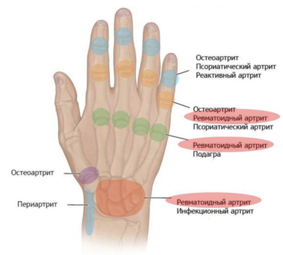 Болят суставы пальцев рук к какому врачу. Псориатический артрит симптомы. Ревматоидный псориатический артрит. Определяющие симптомы ревматоидного артрита. Псориатический артрит схема.