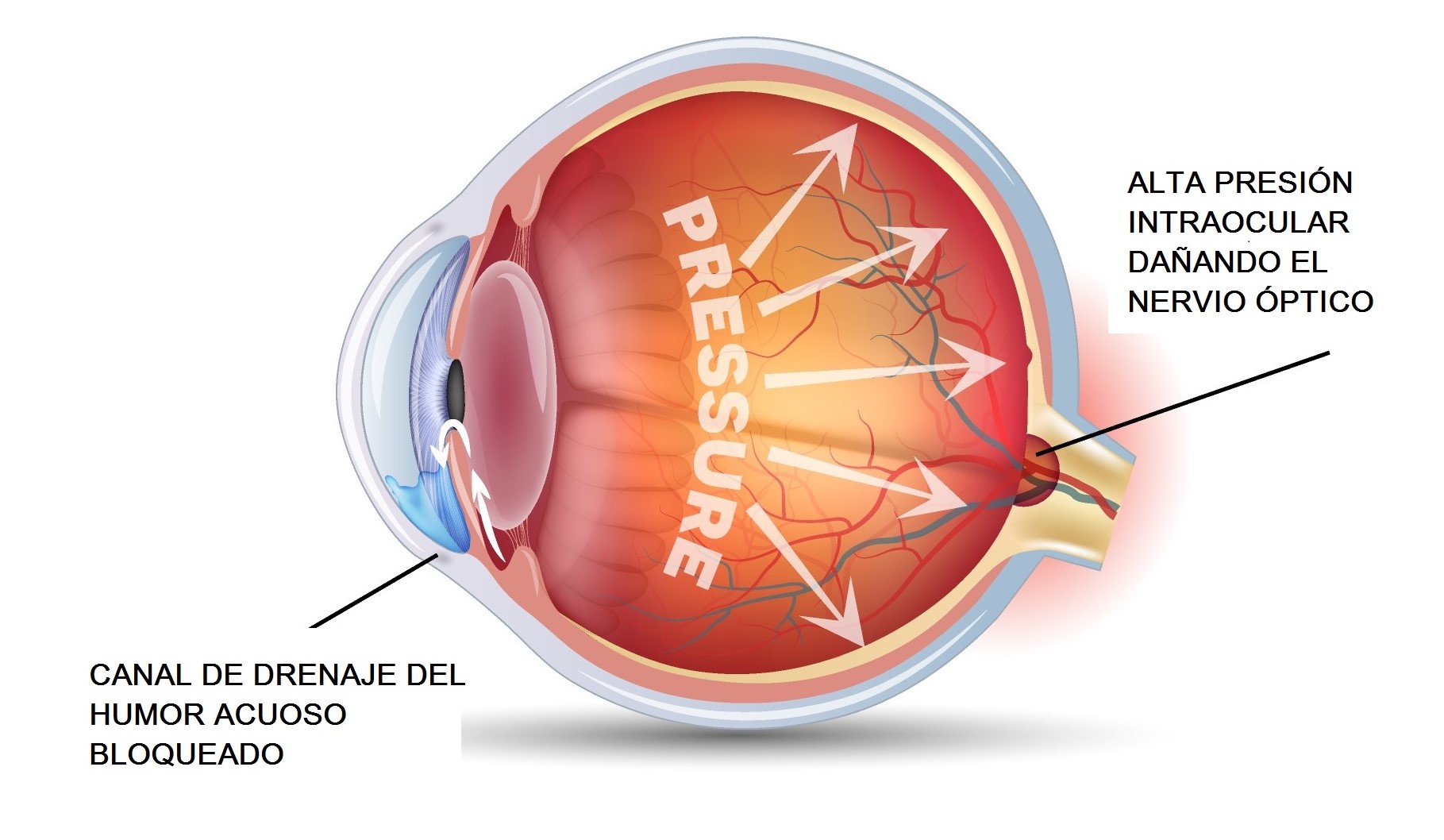 При глаукоме можно применять. Краеугольная глаукома. Глаукома псевдонормального давления. Glaucoma Drainage.